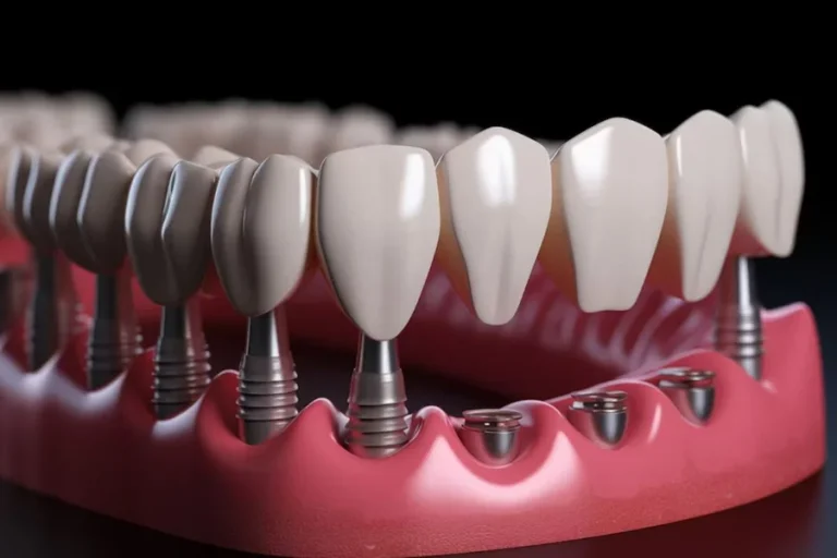 How Dental Implants Improve Function And Confidence Dental Implants