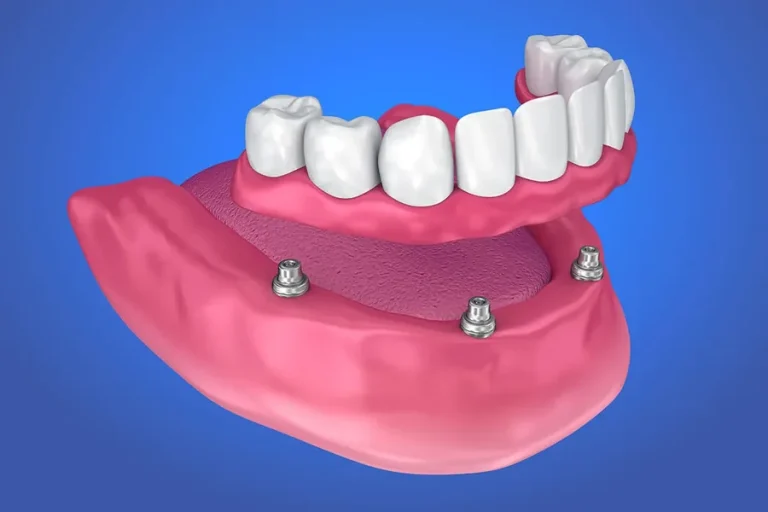 Implant Supported Crowns