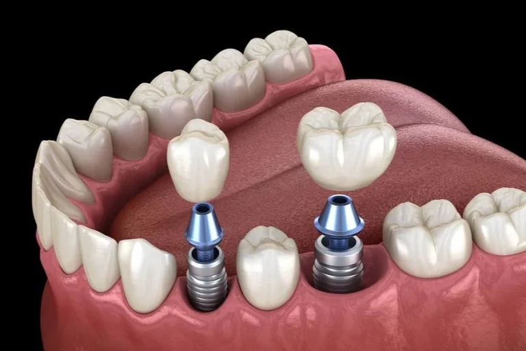 Why Dental Implants Are Designed To Last A Lifetime Dental Implants